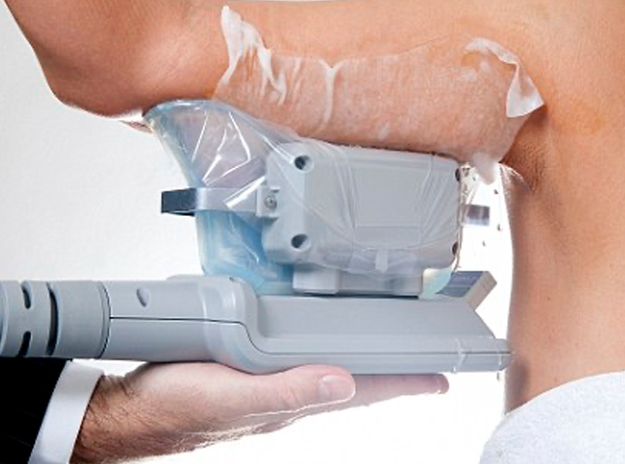 Korting Cryolipolyse behandeling Perfect You Skin Clinic Cryolipolyse behandeling Perfect You Skin Clinic